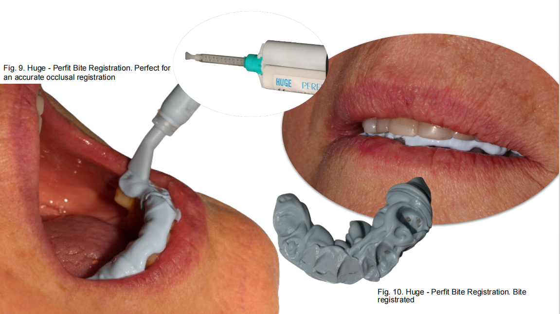 CLINICAL CASES:PERFIT IMPRESSION MATERIALS 4